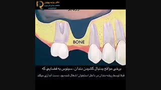 درمان تحلیل استخوان ناشی از بی دندانی