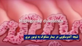 فیلم بررسی تومور مری با استفاده از آندوسکوپی