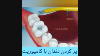 فیلم پر کردن دندان با کامپوزیت