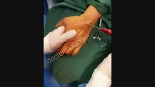 تزریق چربی به دست عصب‌کشی