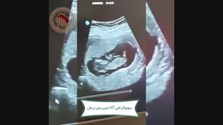 فیلم سونوگرافی nt جنین غیر نرمال