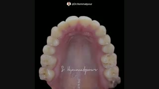 اثر فضای خالی و تیره گوشه دهان بر روی جذابیت لبخند | دکتر  همت پور