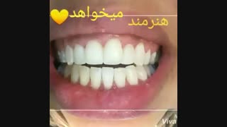 بلیچینگ دندان | دکتر حامد صالحی پروتز دندان