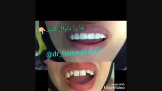 لمینیت دندان | دکتر حامد صالحی لیفت ابرو