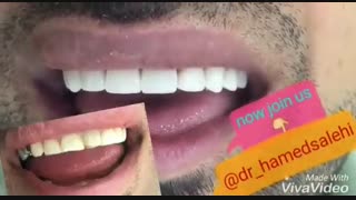 اصلاح طرح لبخند | دکتر حامد صالحی پروتز دندان