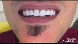 کامپوزیت دندان | دکتر صالحی برداشتن توده