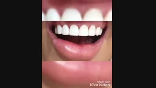 10 واحد کامپوزیت ونیر فک بالا | دکتر صالحی