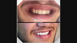 اصلاح طرح لبخند | دکتر حامد صالحی ترمیم ونیر