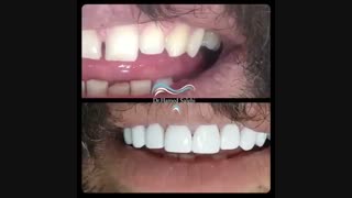 ۸ واحد کامپوزیت ونیر فک بالا | دکتر حامد صالحی