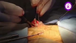 ژنیکوماستی - جراحی سینه در مردان