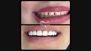 اصلاح طرح لبخند | دکتر حامد صالحی اینسایزینگ