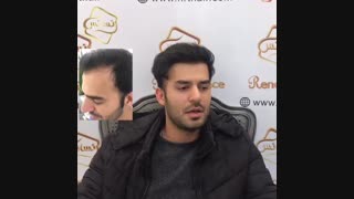 کاشت مو به روشSUT -کلینیک تخصصی رنسانس