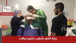 زراعة الشعر بطریقة مایکرو جرافت | عیادة هلیا | 00989120234708