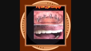 مرکز تخصصی ایمپلنت  ایرانا