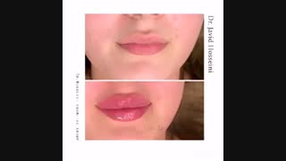 تزریق ژل لب