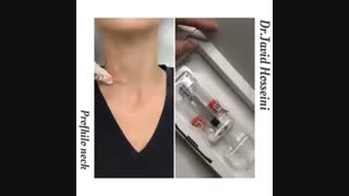 جوانسازی گردن با تزریق پروفایلو