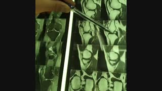 قبل از عمل بازسازی رباط صلیبی