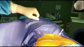 فیلم عمل جراحی دیسک کمر با لیزر