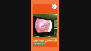 عمل لاپاراسکوپی میومکتومی