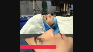 بلافاصله بعد از جراحی بینی | دکتر گلی