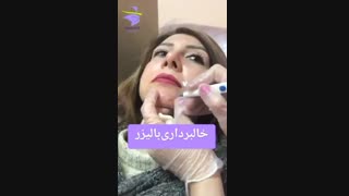 خالبرداری با لیزر