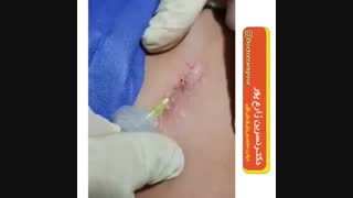 از بین بردن جای زخم ماموپلاستی
