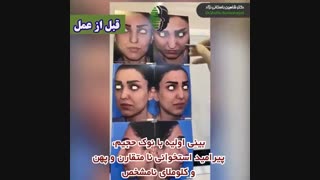 جراحی بینی اولیه با نوک حجیم