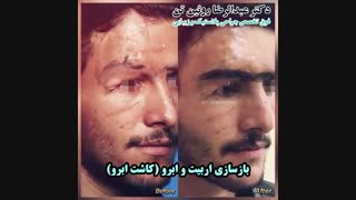 بازسازی اربیت و ابرو