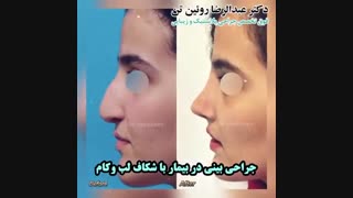 جراحی بینی در بیمار با شکاف لب و کام