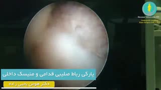 پارگی رباط صلیبی قدامی