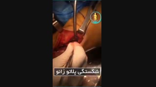 جراحی شکستگی زانو