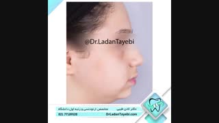 درمان رشدی جهت افزایش رشد فک پایین | دکتر طیبی