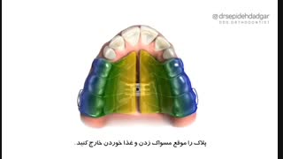 پلاک متحرک ارتودنسی | دکتر سپیده دادگر