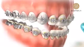 نکاتی که در مسواک زدن حین درمان ارتودنسی باید رعایت کرد | دکتر گرجی