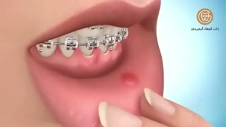 موم ارتودنسی | دکتر فرهاد گرجی تزریق ژل