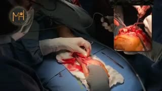 تومور بزرگ چشم و انتقال فری فلپ