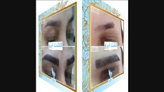 کاشت ابروی طبیعی با بروز ترین روش های روز دنیا
