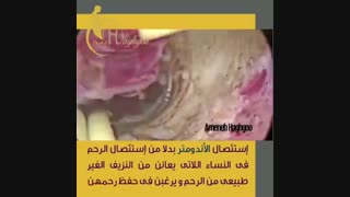 اندومتریوز