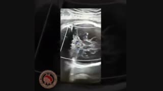 فیلم سونوگرافی مغز جنین