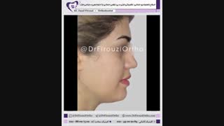 اصلاح ناقرینگی فکی با ارتودنسی و جراحی فک | دکتر فیروزی