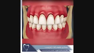 بیماری خفیف لثه (ژنژویت) | دکتر زینب رضایی اسفهرود لیفت گردنایمپلنت دندان