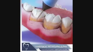 پریودنتیت (بیماری پیشرفته لثه) | دکتر زینب رضایی اسفهرود جراحی فک