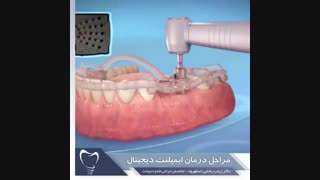مراحل درمان ایمپلنت دیجیتال | دکتر زینب رضایی اسفهرود