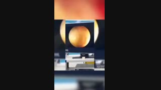 فیلم عمل جراحی سنگ کلیه آندوسکوپی