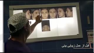 فیلم قبل از عمل زیبایی بینی