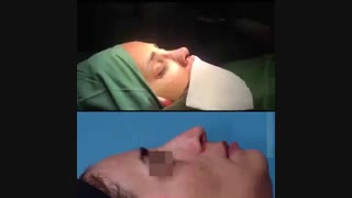 جراحی بینی اولیه در بیماری با عدم تقارن