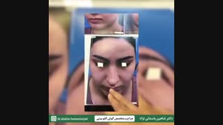 جراحی بینی