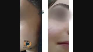 تزریق فیلر به گونه