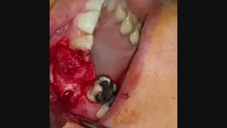 ایمپلنت دندان