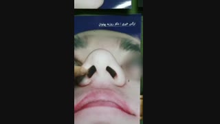 جراحی بینی طبیعی